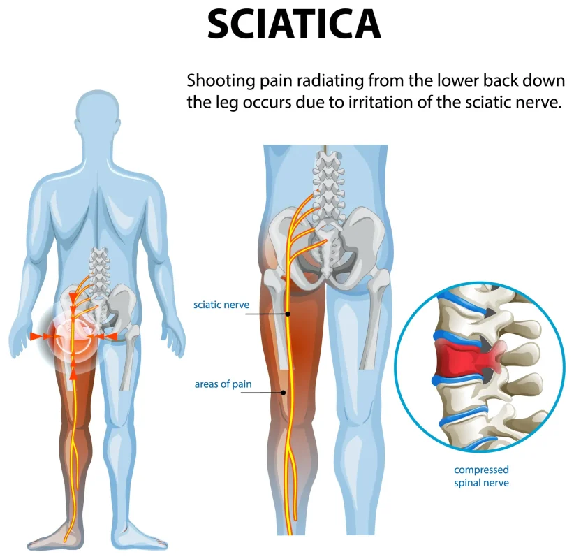 What Is Sciatica